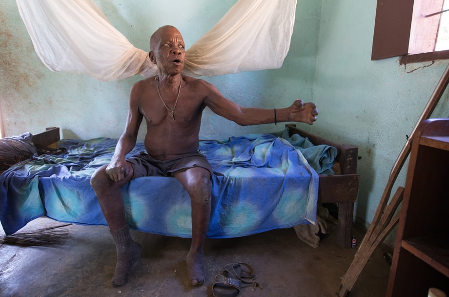 John Flomo, 66, has lived at the Ganta Leprosy and TB Rehab Center since he was 15 years old. The center is part of the United Methodist Ganta Mission Station in Ganta, Liberia. Photo by Mike DuBose, UMNS.