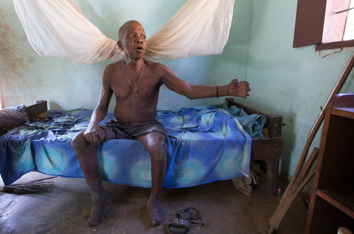 John Flomo, 66, has lived at the Ganta Leprosy and TB Rehab Center since he was 15 years old. The center is part of the United Methodist Ganta Mission Station in Ganta, Liberia. Photo by Mike DuBose, UMNS.