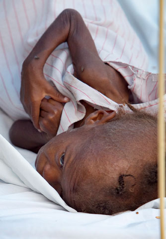 Winsley Polo, 2, lies in her crib outdoors beneath a tarp at Grace Children's Hospital in Port-au-Prince, Haiti, following the January 2010 earthquake. Church leaders have been advocating for ministries with the poor amid calls to cut federal spending. A UMNS file photo by Mike DuBose.